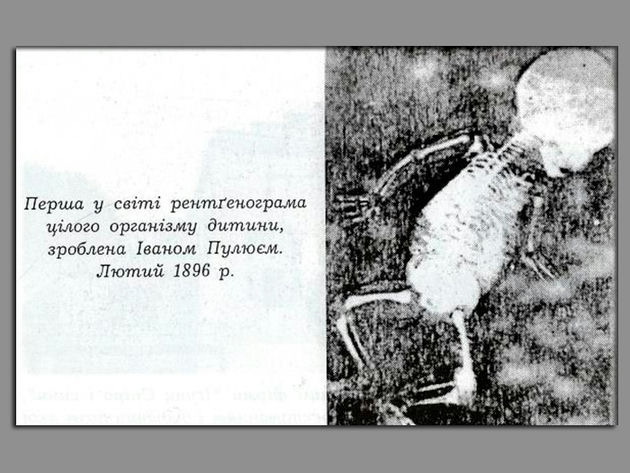 Перша в світі рентгенограма цілого організму дитини. Автор Іван Пулюй